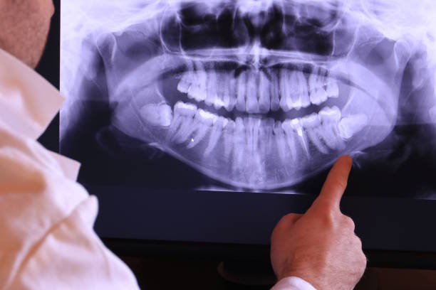 Best Emergency Wisdom Teeth Removal in Canfield, OH